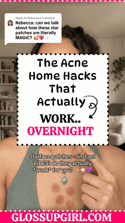 acne home hacks that clear skin overnight