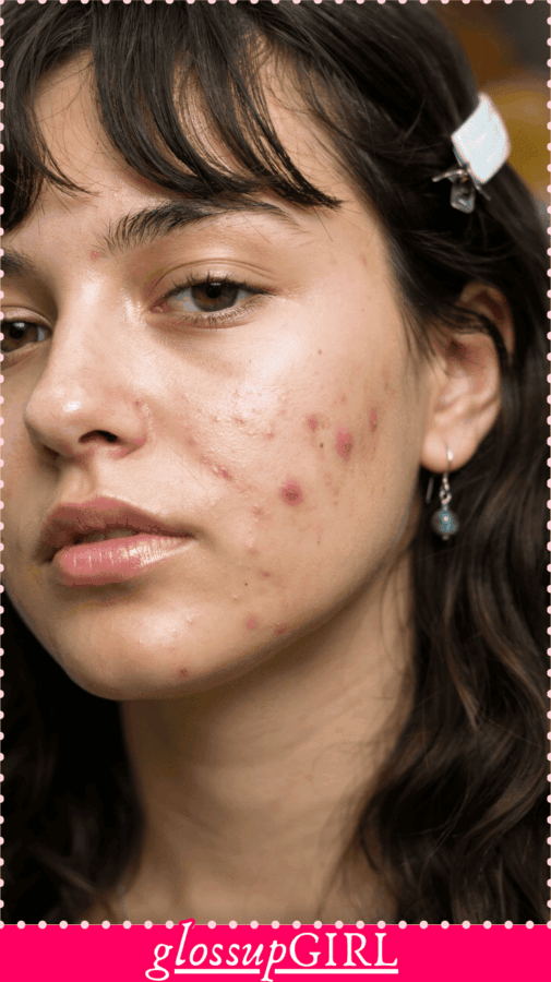 acne home hacks that clear skin overnight