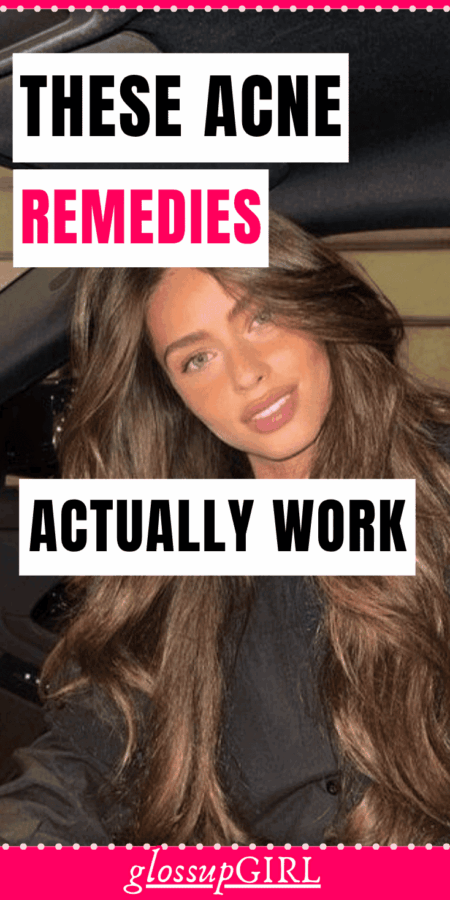 acne home hacks that clear skin overnight