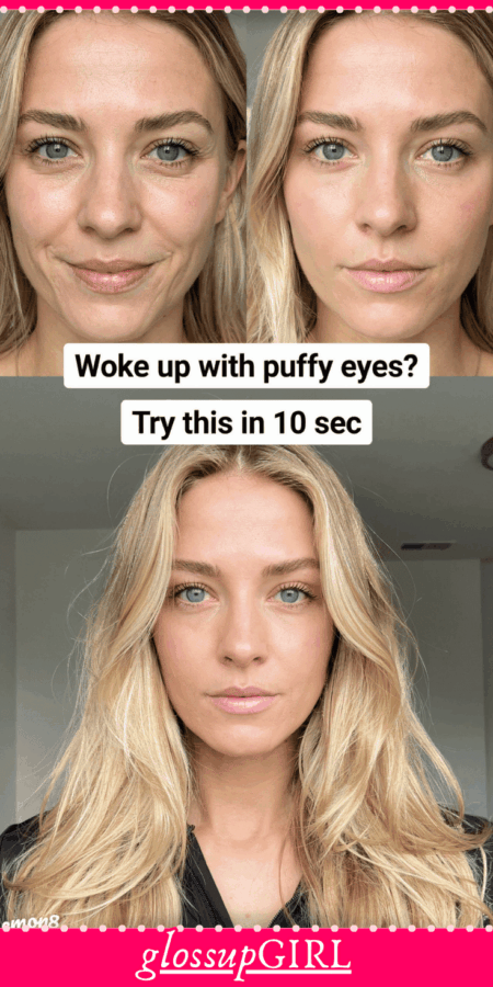 puffy eye remedies